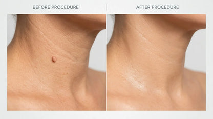Kit Anti-Acrochordons Naturel — ClartéSkin