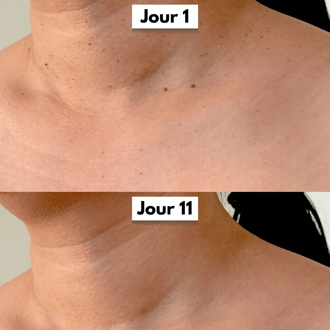 Kit Anti-Acrochordons Naturel — ClartéSkin
