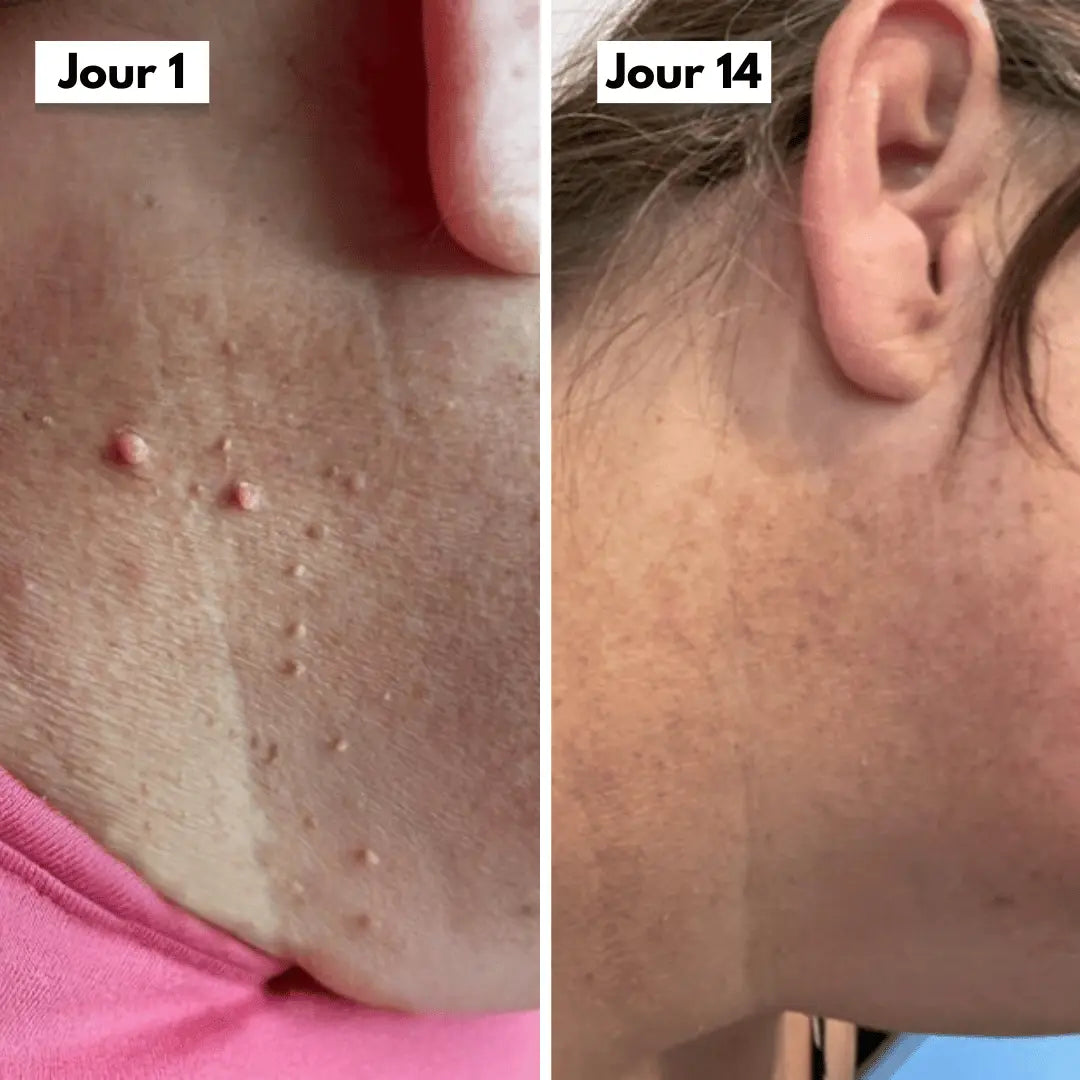 Kit Anti-Acrochordons Naturel — ClartéSkin