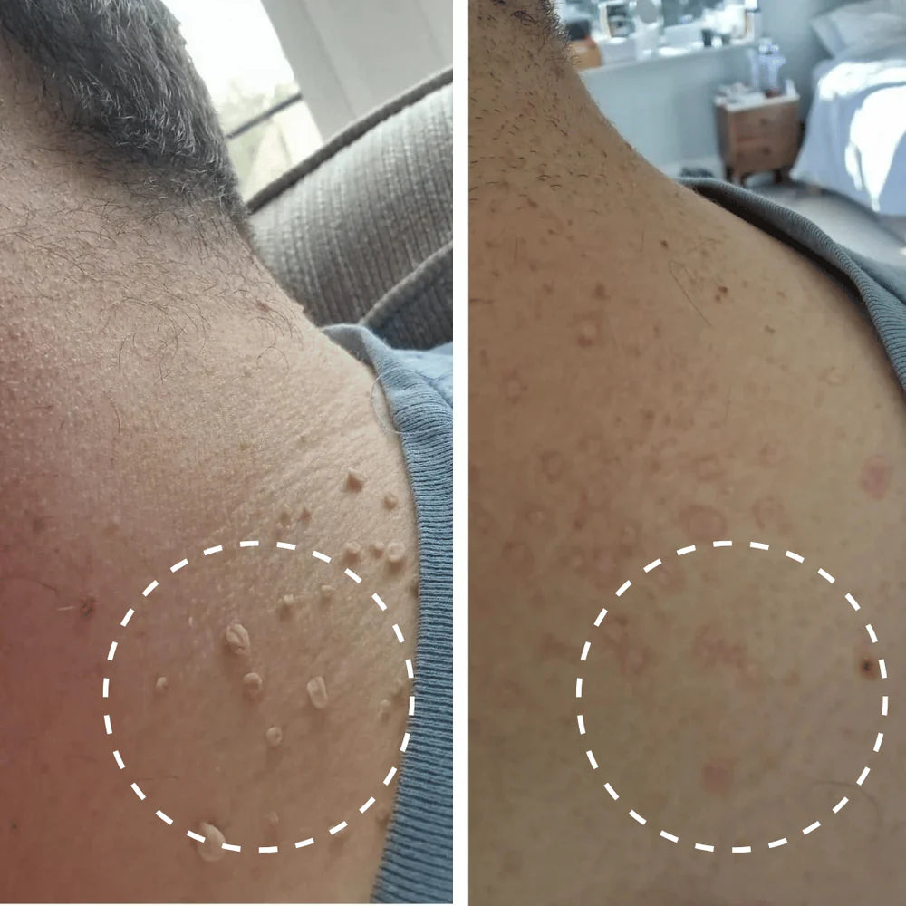 Kit Anti-Acrochordons Naturel — ClartéSkin