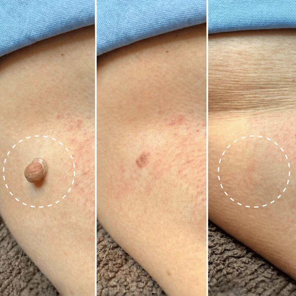 Kit Anti-Acrochordons Naturel — ClartéSkin