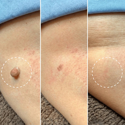 Kit Anti-Acrochordons Naturel — ClartéSkin