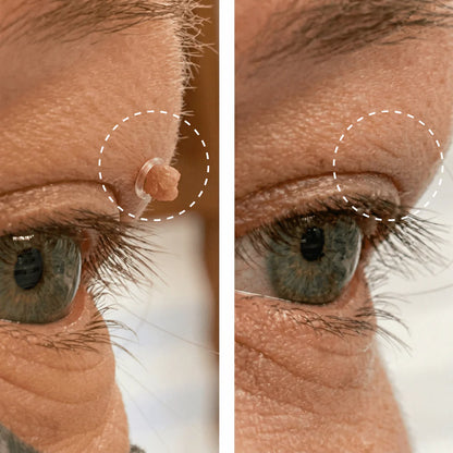 Kit Anti-Acrochordons Naturel — ClartéSkin