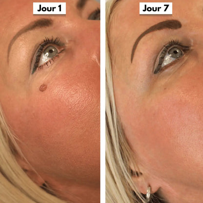 Kit Anti-Acrochordons Naturel — ClartéSkin